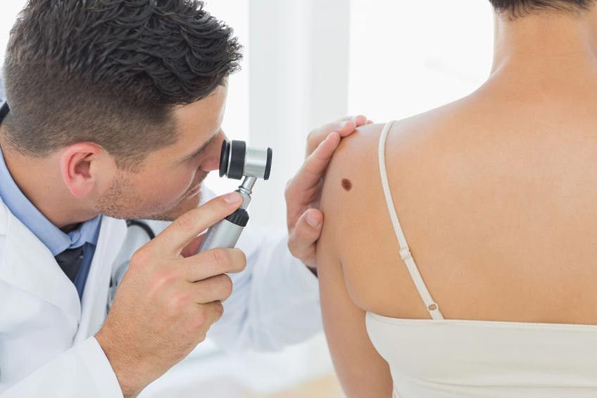 Inilah Tanda Tahi Lalat yang Berbahaya