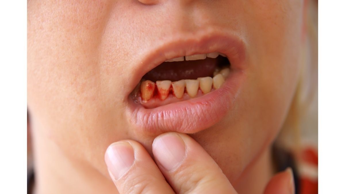 Coba Perhatikan, Penyebab Gusi Berdarah saat Hamil