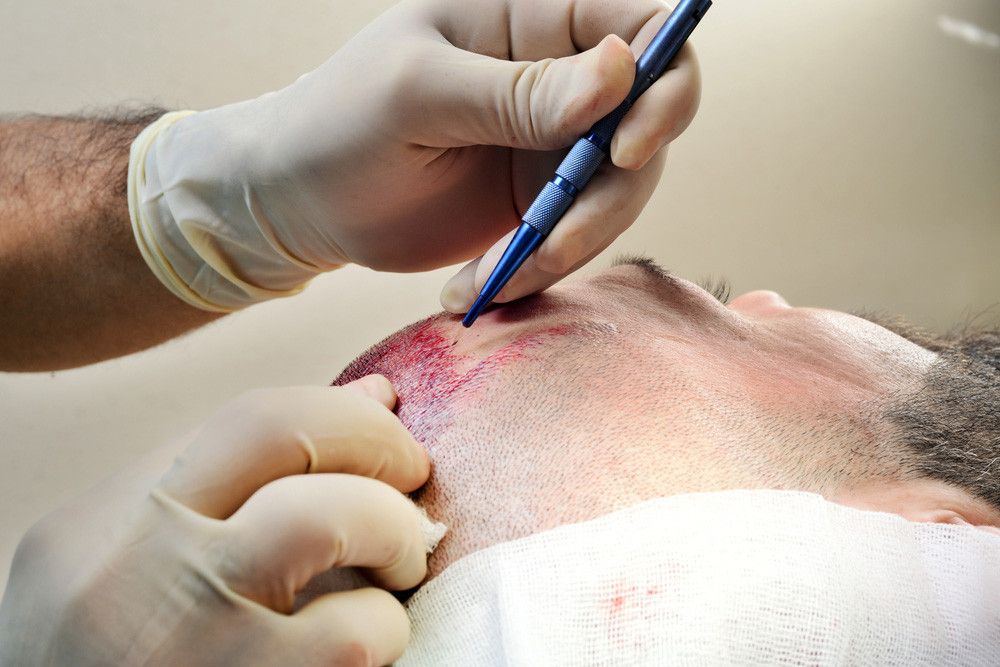 Implan Rambut, Cara Efektif Atasi Kebotakan pada Pria