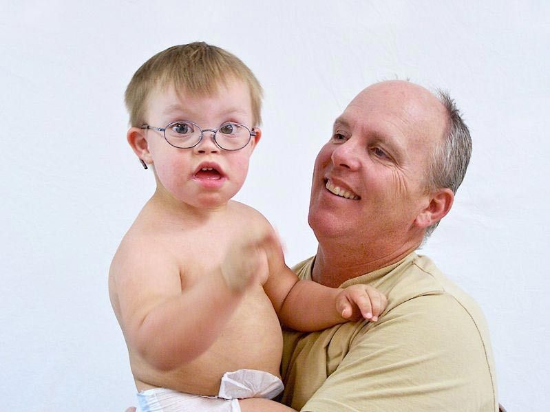 Alergi pada Anak dengan Sindrom Down