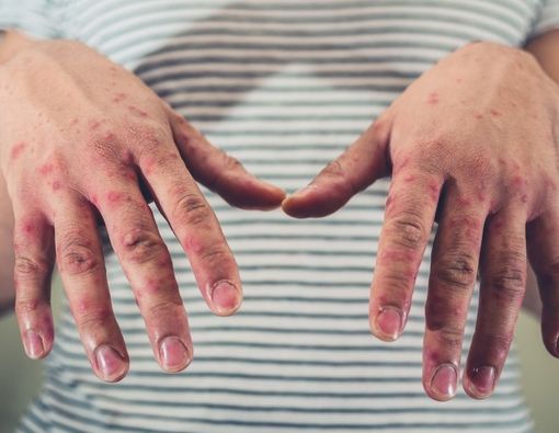 Komplikasi Flu Singapura yang Mesti Anda Waspadai