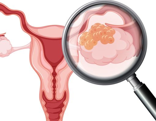 Gejala Awal Kanker Serviks Sesuai Stadium