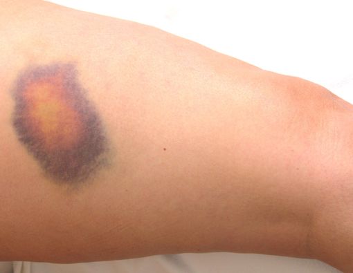 Cara Mudah Menghilangkan Memar yang Bisa Anda Coba