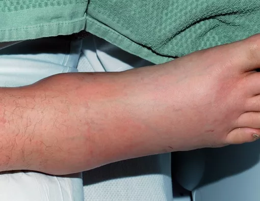 Kaki Sering Bengkak dan Nyeri? Awas Penyakit Paru Kronis