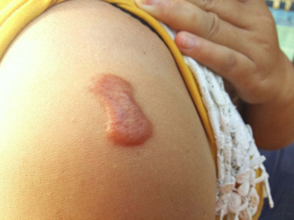 Penyebab Munculnya Keloid di Kulit