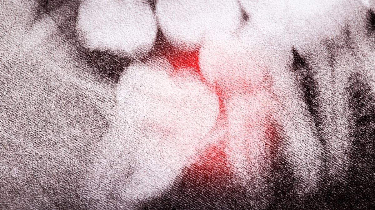 Penyebab Impaksi Gigi yang Harus Kamu Waspadai