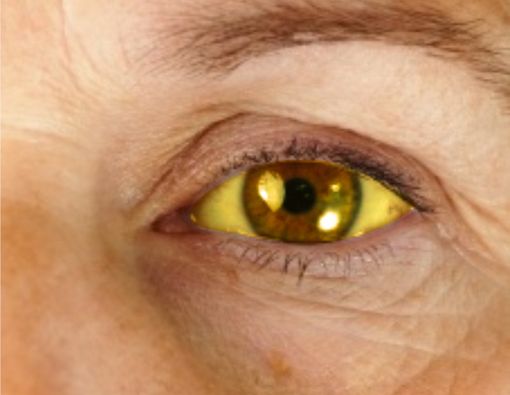 9 Penyebab Mata Kuning yang Harus Diwaspadai