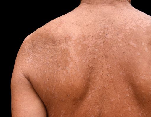 Hati-hati, Ini Beda Gejala Kusta dan Panu!