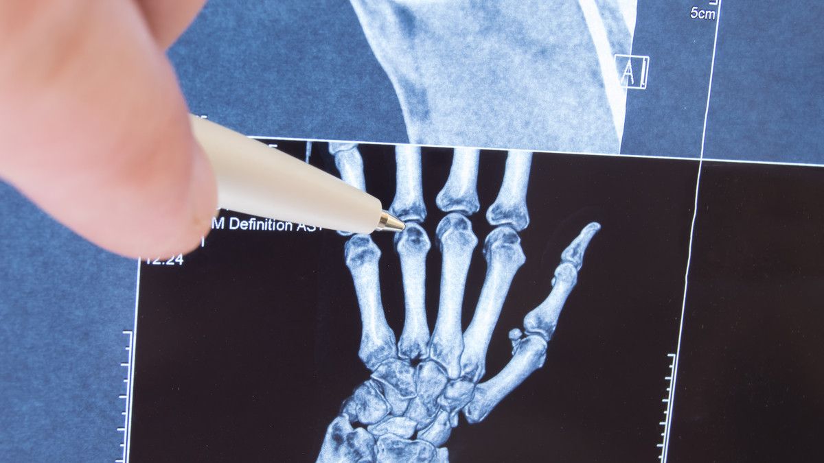 Cara Merawat Anak yang Mengalami Juvenile Rheumatoid Arthritis