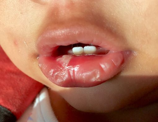 Sariawan pada Bayi Akibat Kurang Nutrisi atau Penyakit?