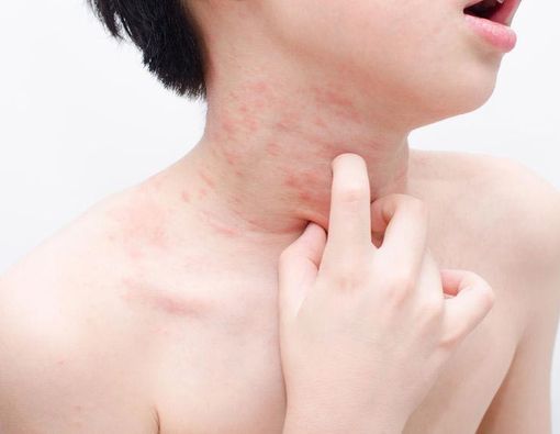 Cara Membedakan Bentol Karena Alergi dan Gigitan Nyamuk