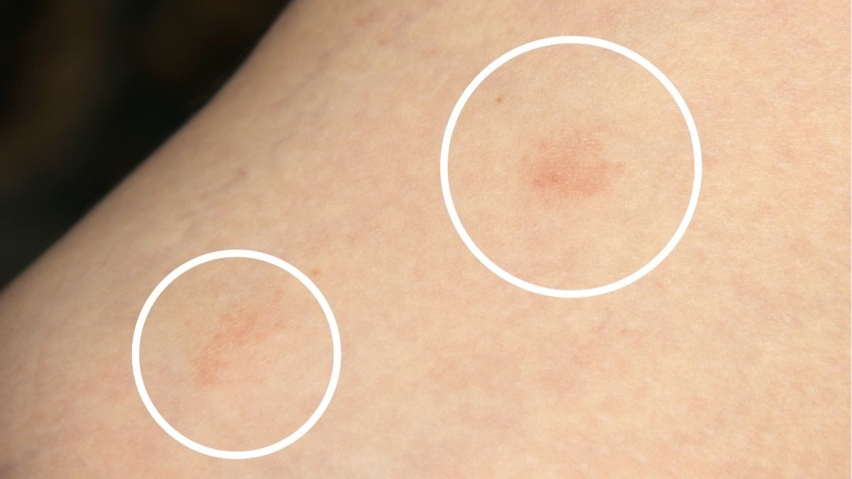 Kenali Pityriasis Alba, Bintik Putih di Kulit yang Mirip Panu