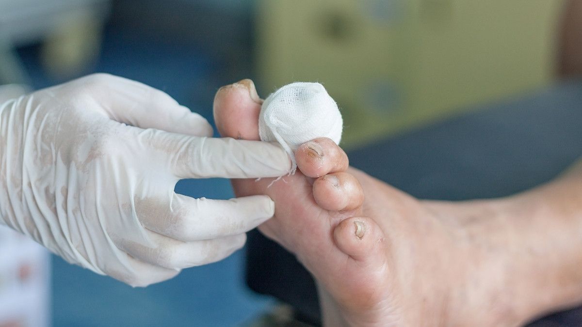 Mengenal Kondisi Kulit Melepuh Akibat Diabetes