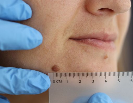 Waspada Kutil Bisa Menular, Kenali Penyebab dan Cara Penyebarannya