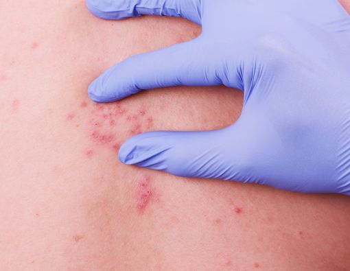 Harus Waspada, Ini Risiko Kesehatan Cacar Api pada Ibu Hamil