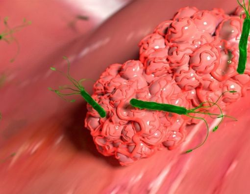 Syringoma, Tumor Jinak di Area Pipi dan Kelopak Mata