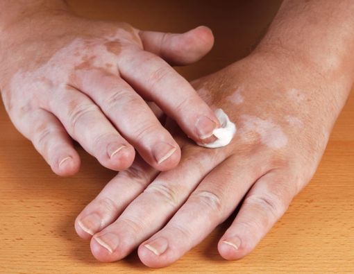 Muncul Bercak Putih Vitiligo? Ini 4 Obat Untuk Kurangi Gejalanya