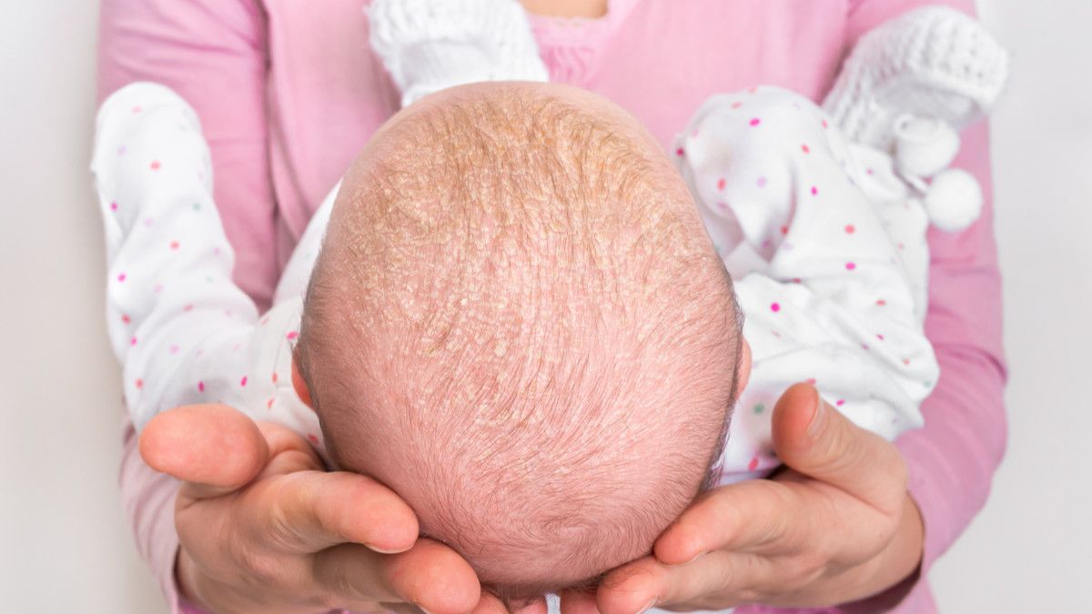 Ketombe Pada Bayi, Ini Cara Mengatasinya