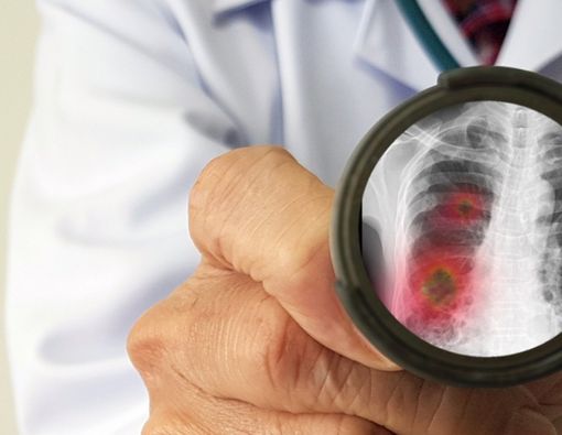 Teknologi VR Scan Paru-paru Pasien Virus Corona, Ini Kondisinya