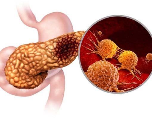 Operasi Whipple untuk Mengatasi Kanker Pankreas