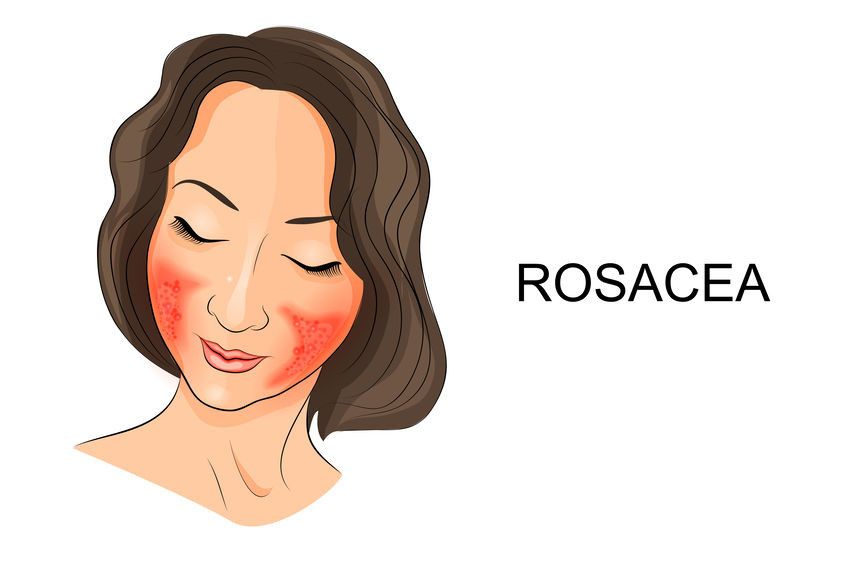 7 Makanan Ini Memicu Gangguan Kulit Rosacea