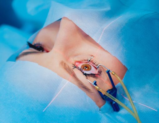 Usai LASIK, Tak Perlu Kacamata Seumur Hidup?