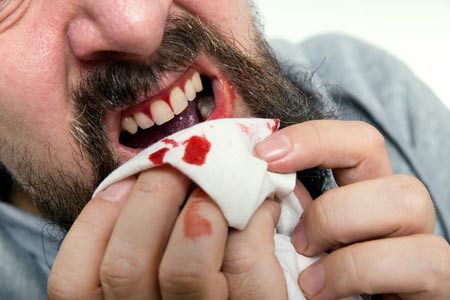 Awas, Penyakit Terselubung di Balik Gusi Berdarah
