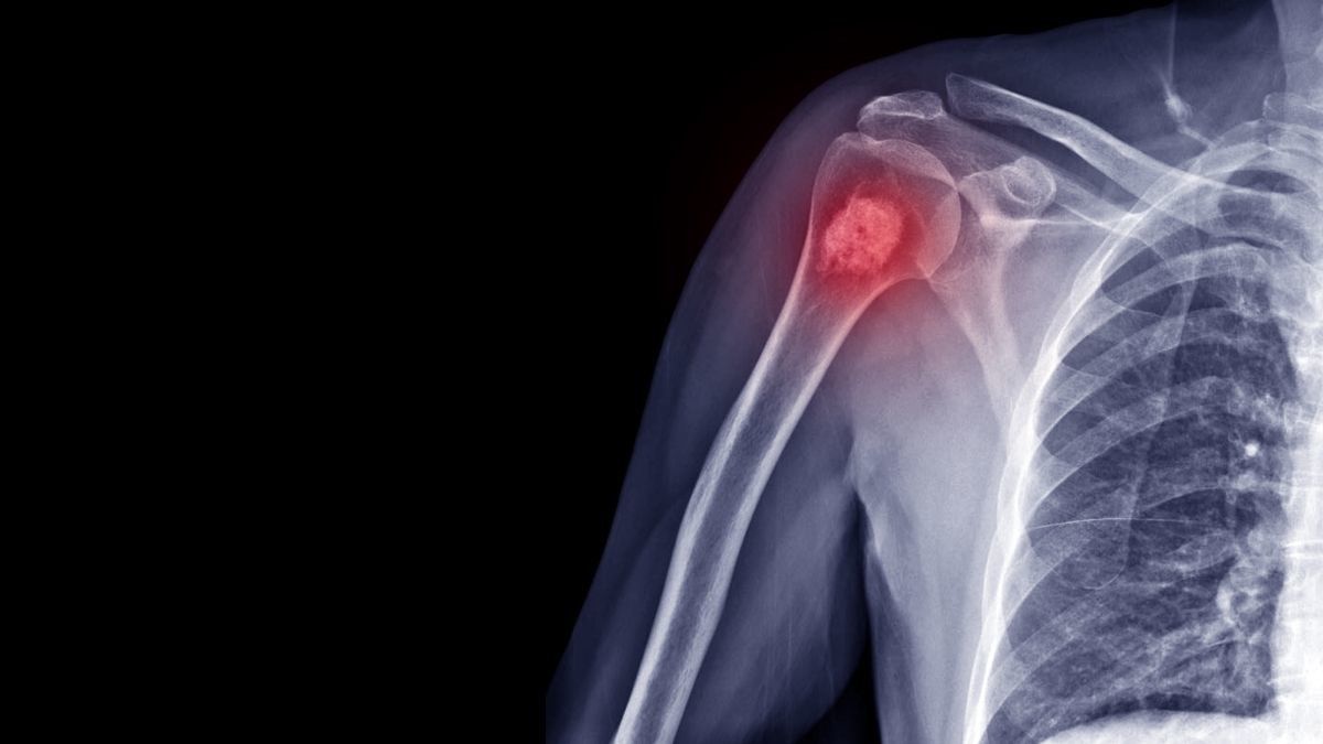 Mengenal Prosedur Limb Salvage untuk Mengatasi Kanker Tulang