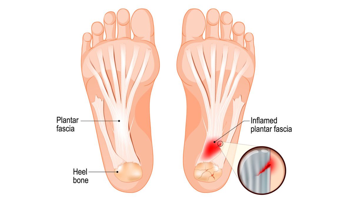 Tips Meredakan Nyeri Tumit Plantar Fasciitis