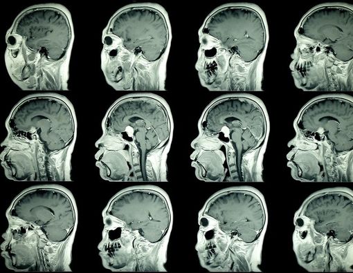 Efek Samping yang Mungkin Terjadi Pascaoperasi Kanker Otak