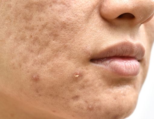 Mengobati Luka Cakar pada Wajah agar Tidak Sebabkan Bopeng