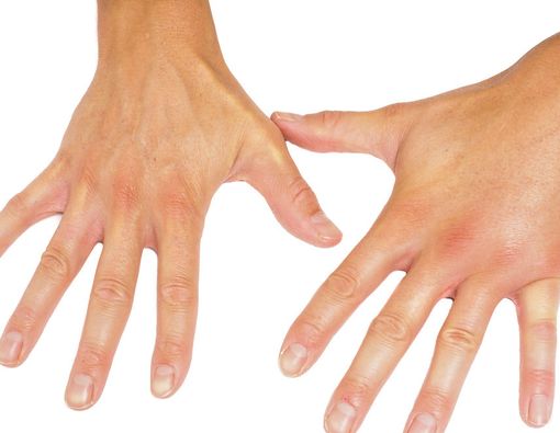 Kenali 6 Penyebab Jari Bengkak