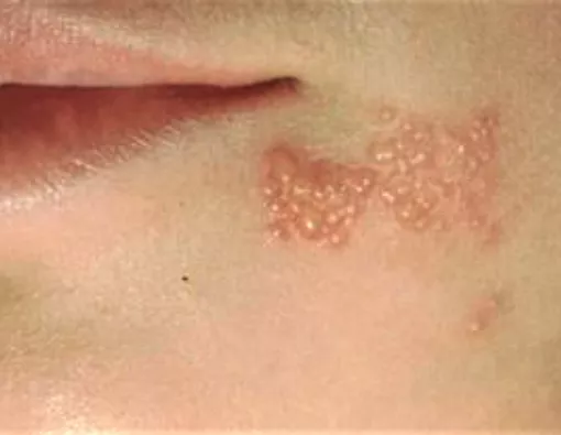 Herpes di Wajah, Waspada Herpes Zoster Oftalmikus