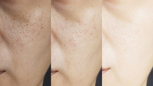 Tren Memutihkan Kulit dengan Glutathione, Amankah?