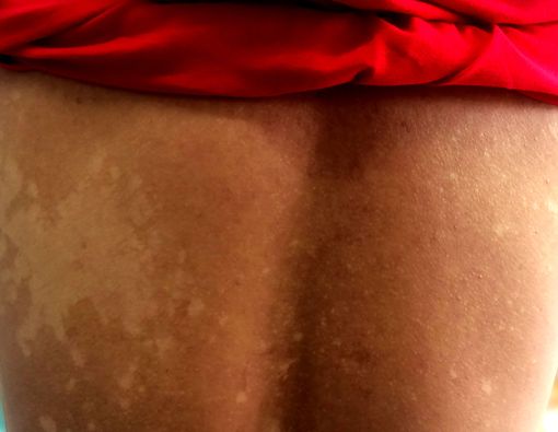 2 Cara Ampuh Mengobati Panu yang Perlu Anda Tahu