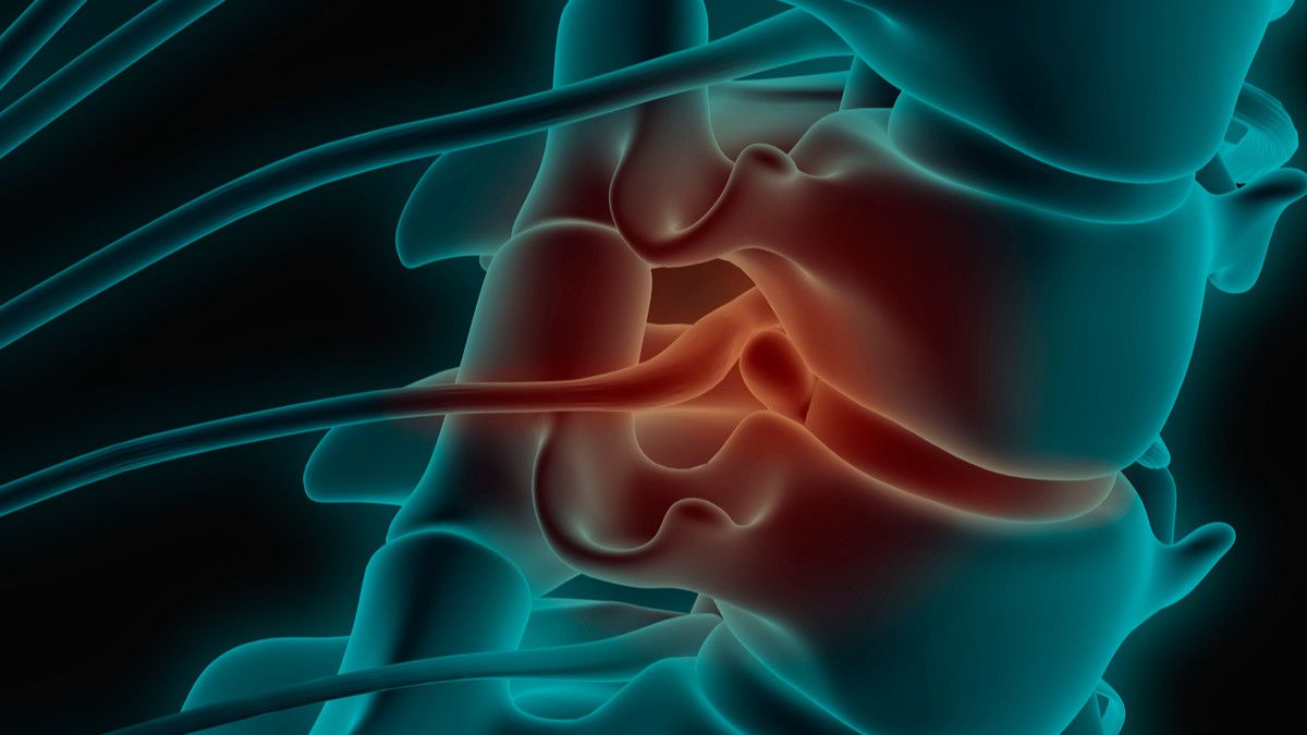 Mengalami Saraf Kejepit, Bisakah Disembuhkan?