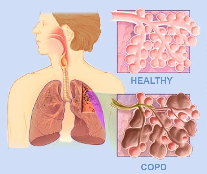 Awas Penyakit Paru Obstruktif Kronik