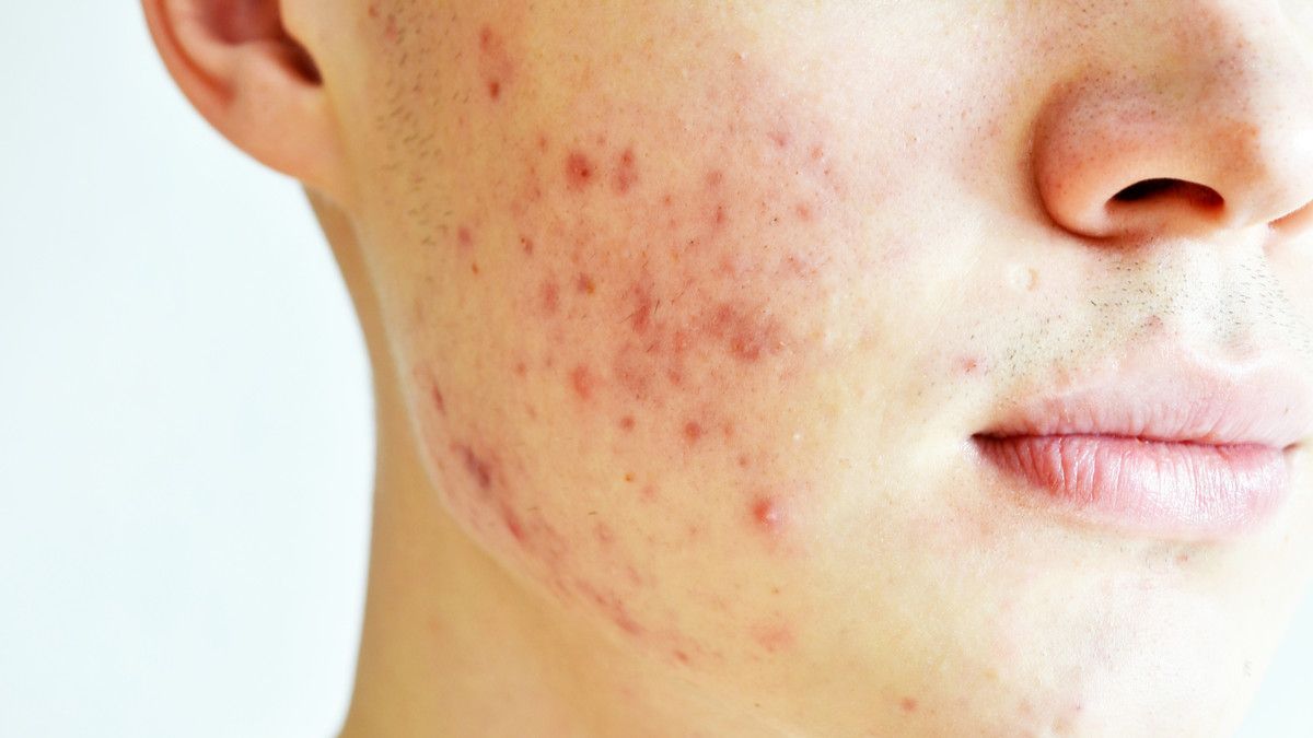 Seorang Pria Memiliki Jerawat