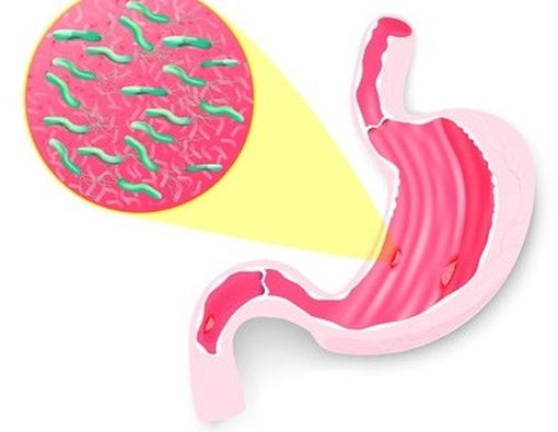 Tukak Lambung, Bukan Sakit Maag?