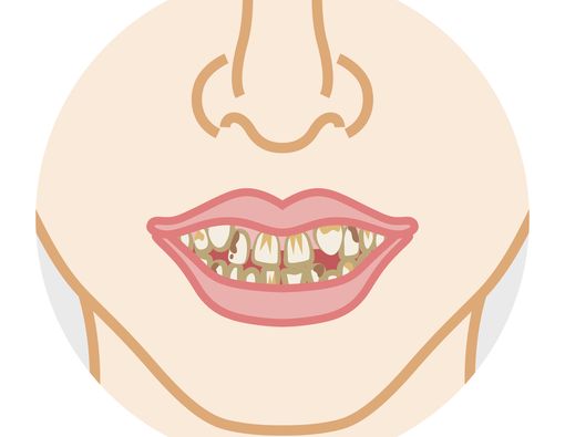 Kondisi Gigi Buruk Bisa Sebabkan Kanker Mulut?