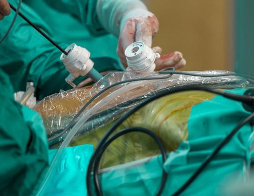 Persiapan Hingga Efek Samping Operasi Endometriosis