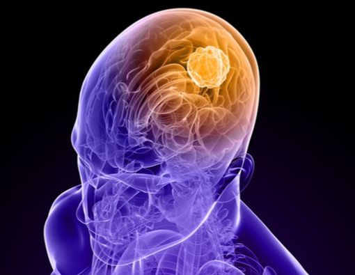 Kenali Kanker Otak dari 6 Tanda Ini
