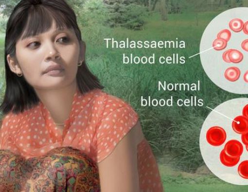 Tak Bisa Disembuhkan, Apa Penyebab Thalassemia?