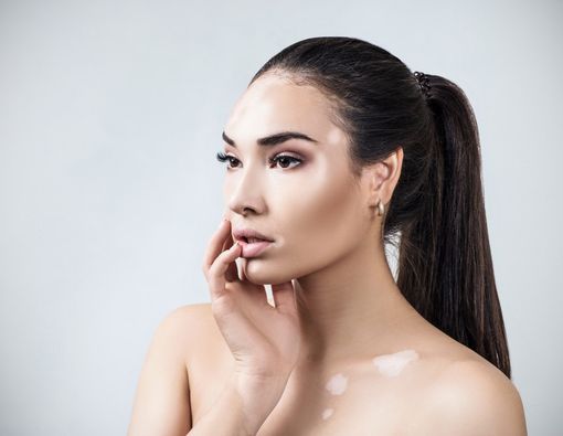 Penyebab Bercak Putih di Wajah