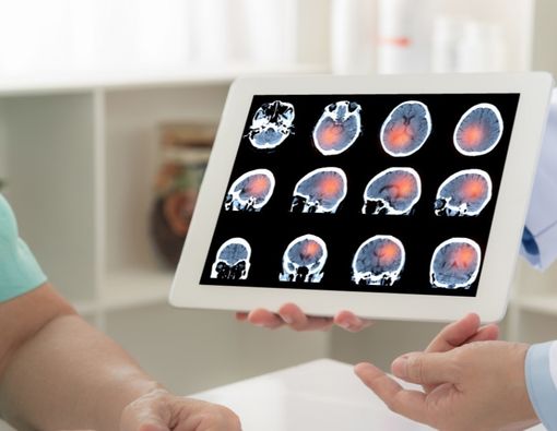 Waspada, Gegar Otak Dapat Memicu Diplopia