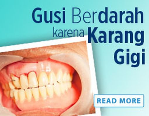 Gusi Berdarah karena Karang Gigi