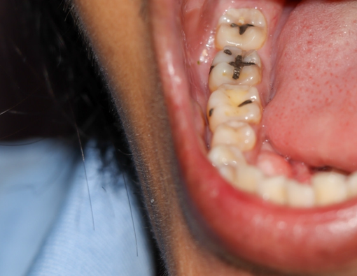 Punya Gigi Berlubang, Bolehkah Melakukan Veneer?