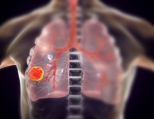 Bahaya Makanan Masuk ke Paru-paru