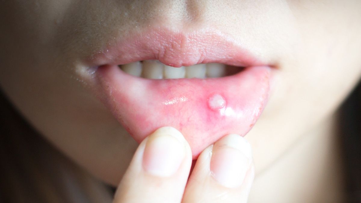 6 Bahan Alami untuk Mengatasi Sariawan yang Mengganggu (C.PIPAT/Shutterstock)