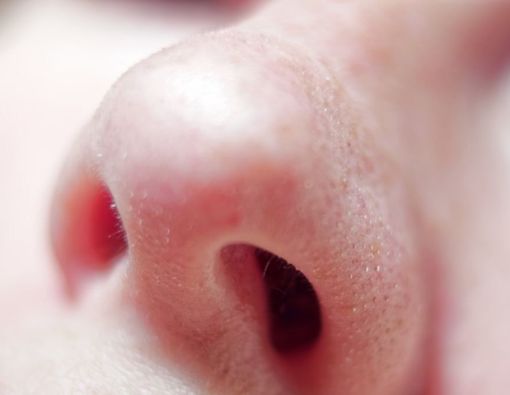 Punya Bentuk Hidung Jambu? Waspada Kelainan Rinofima